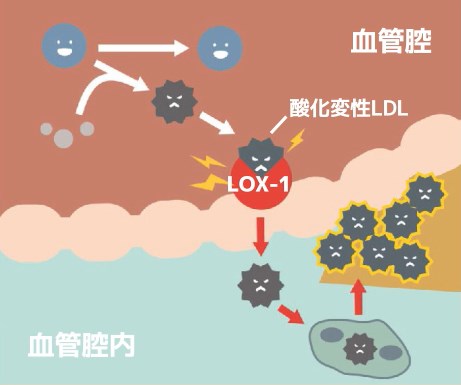 動脈硬化のメカニズム